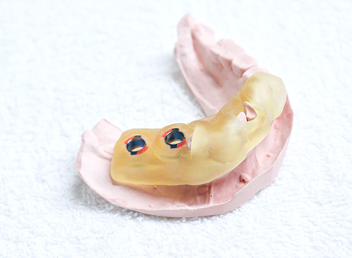 手術の安定性を高めるガイデッドサージェリー