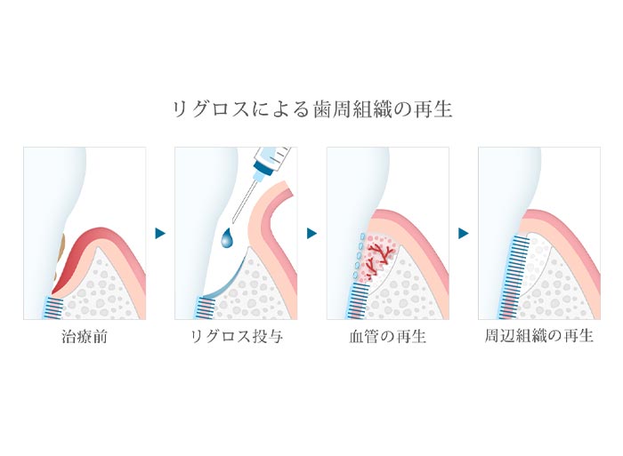 歯周組織再生療法を行っています